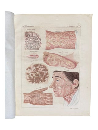 Ikonographische Darstellung der nicht-syphilitischen Hautkrankheiten. Mit darauf bez&uuml;glichem systematischem Texte.